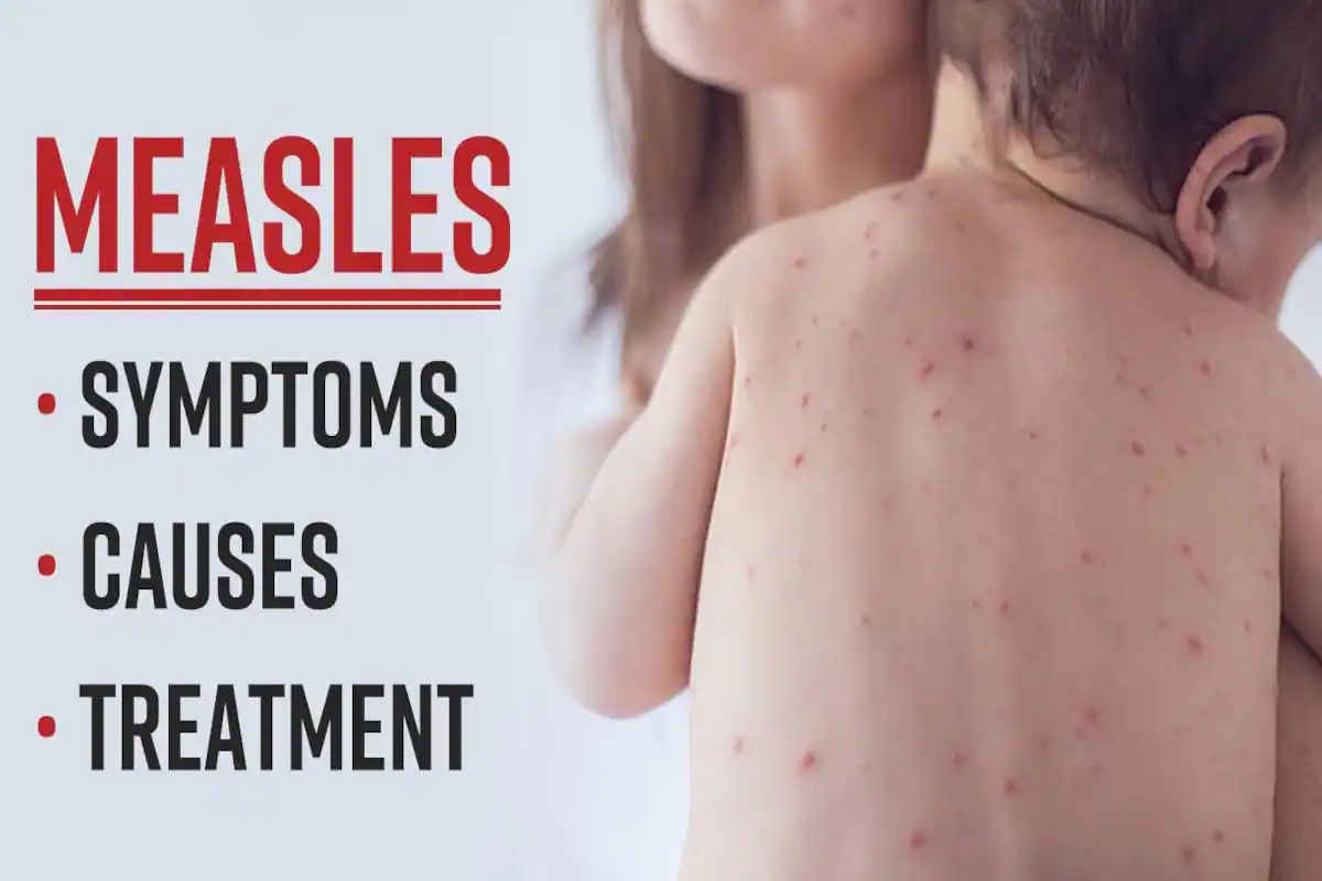 Measles