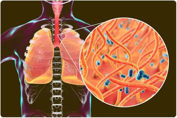 Whooping Cough